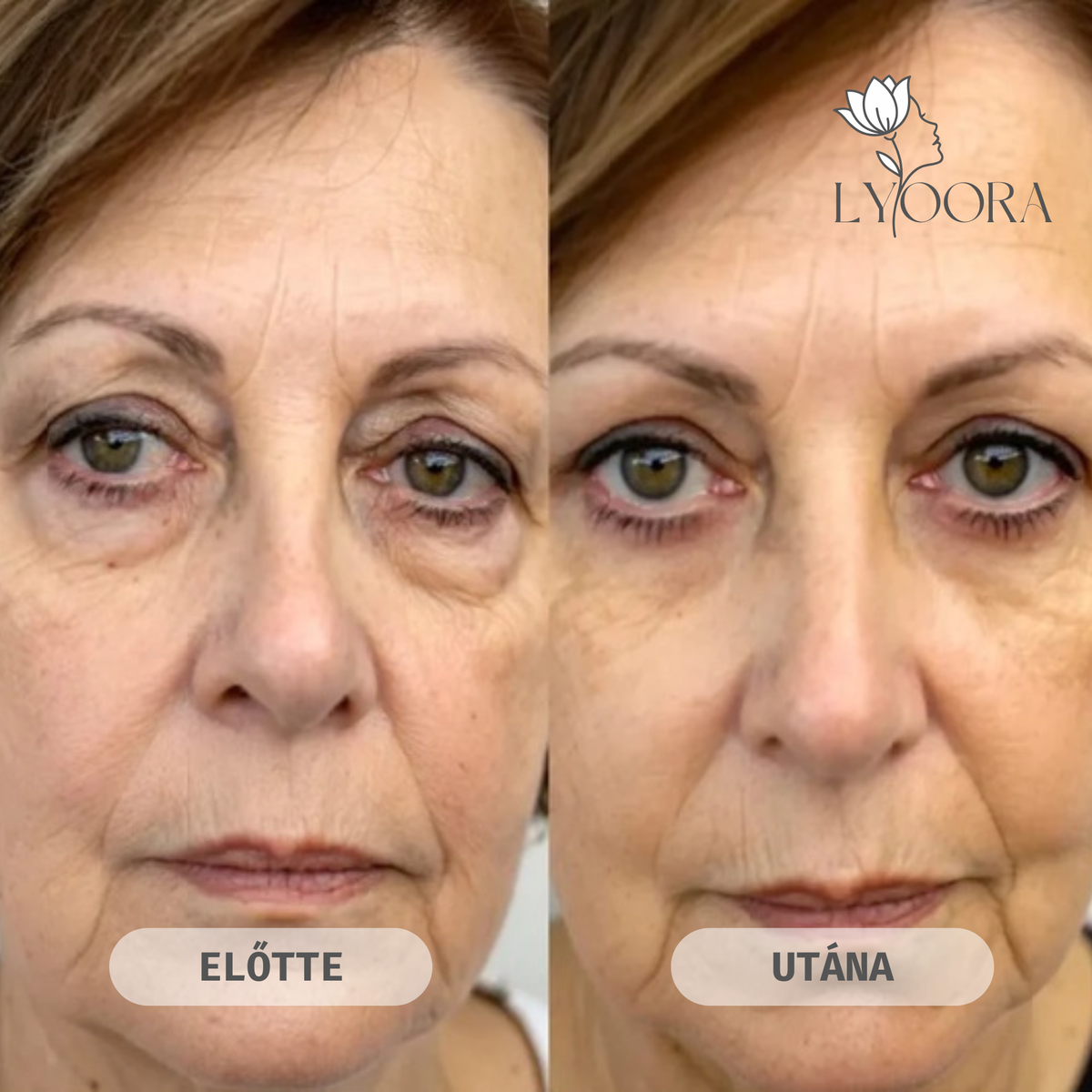 Glow Eye Lift Duo — Vörösfény és EMS szemkörnyék-feszesítő
