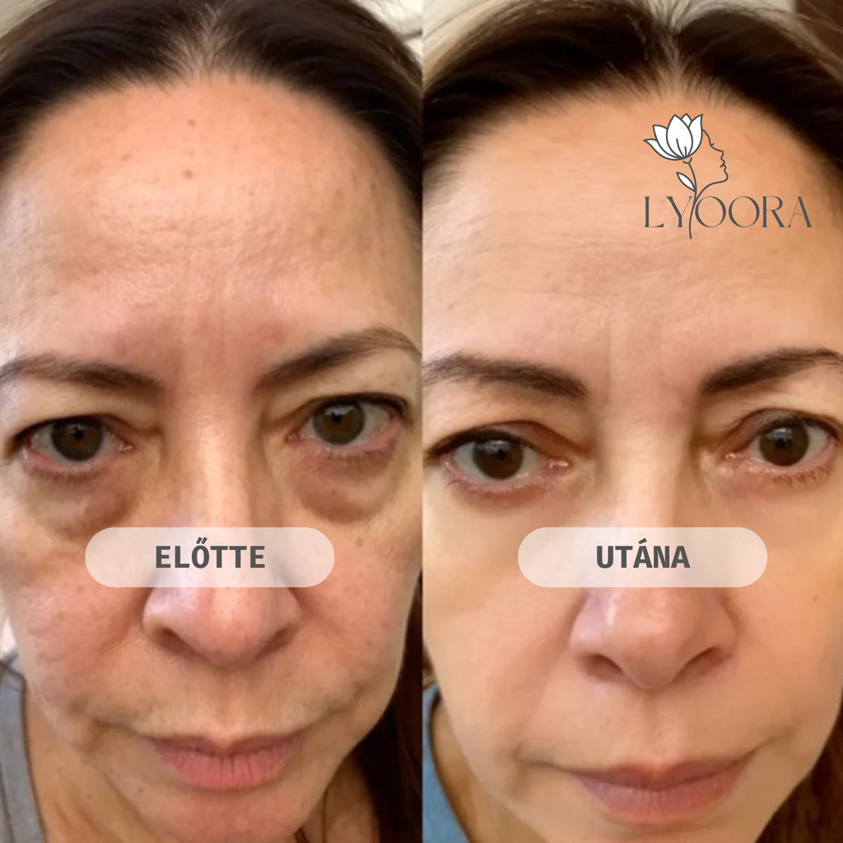 Glow Eye Lift Duo — Vörösfény és EMS szemkörnyék-feszesítő