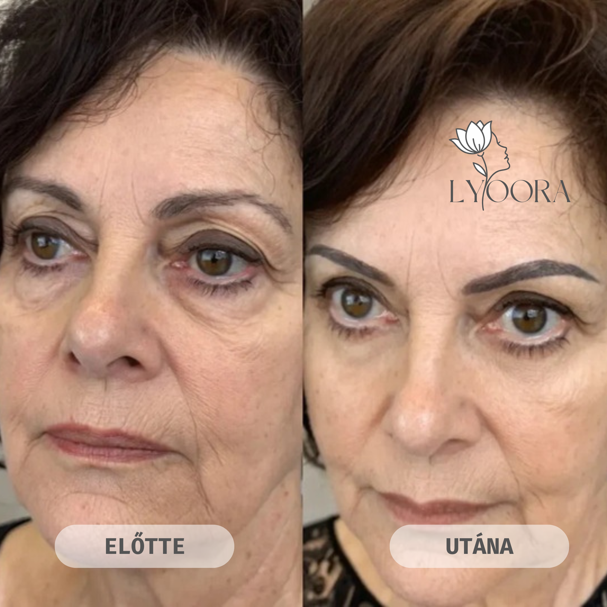 Glow Eye Lift Duo — Vörösfény és EMS szemkörnyék-feszesítő